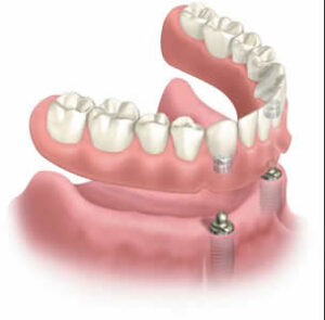 Implant Retained Dentures - Queen’s Park Dental