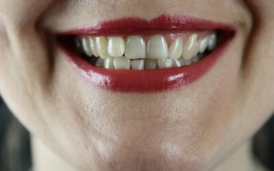 Straight Talk: Understanding Crooked Teeth and Your Options at Queen’s Park Dental, New Westminster